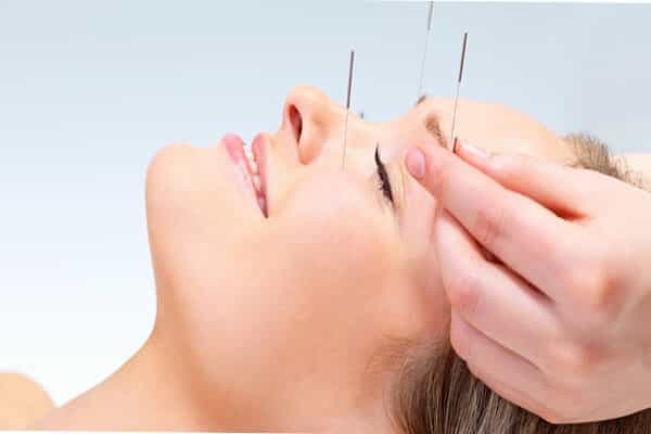 Acupuncture